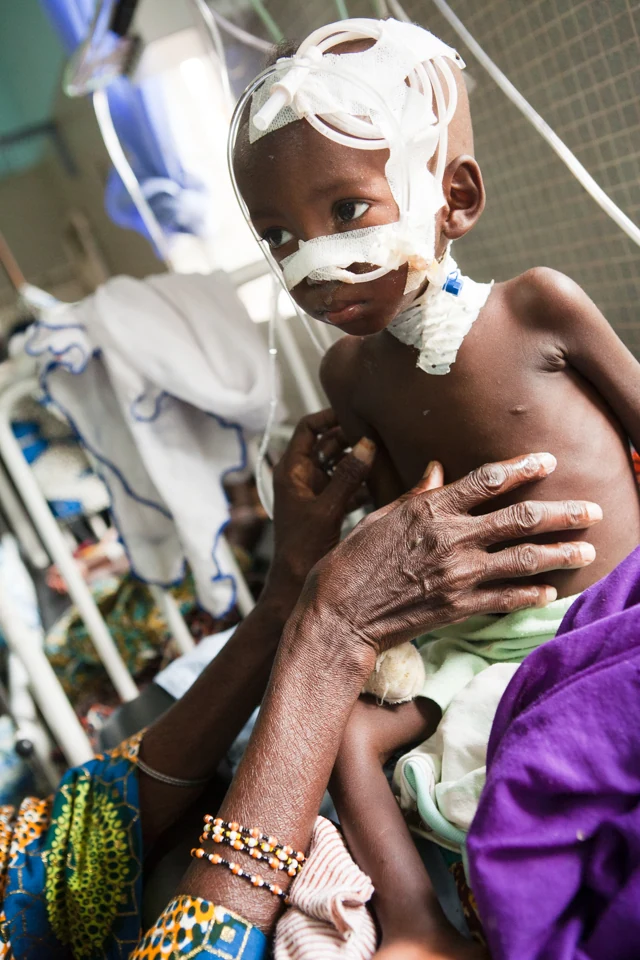 Un enfant soigné à l’hôpital St-Jean de Dieu, au Bénin.